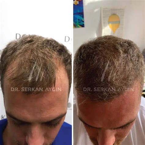 Hair Transplant in Turkey I Dr.Serkan Aygin Clinic .